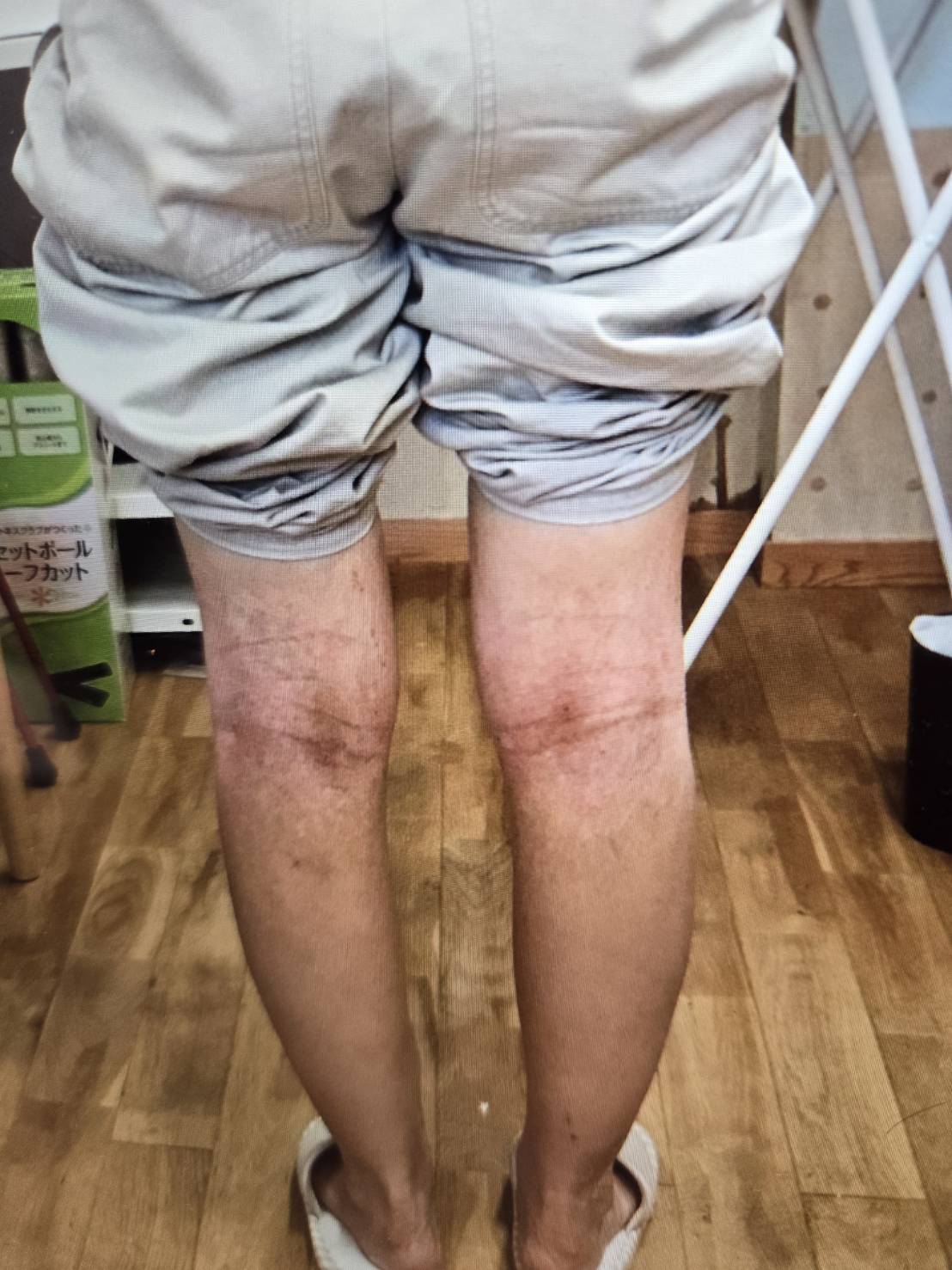 アトピー税皮膚炎で悩んでいる方のの施術結果の施術前