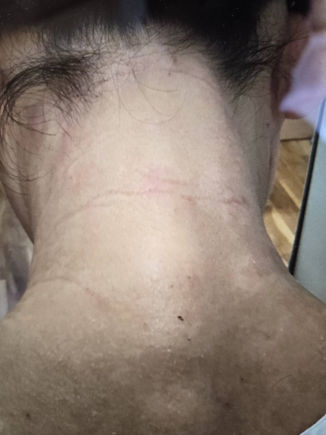 アトピー税皮膚炎で悩んでいる方のの施術結果の施術前