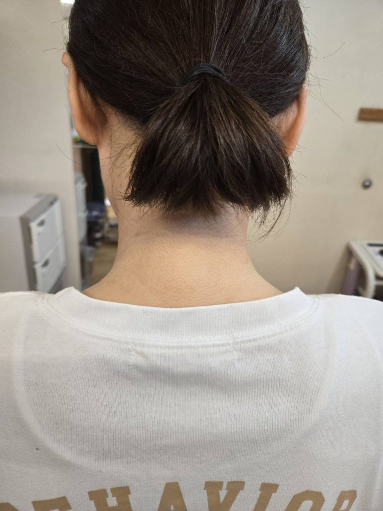 アトピー税皮膚炎で悩んでいる方のの施術結果の施術後